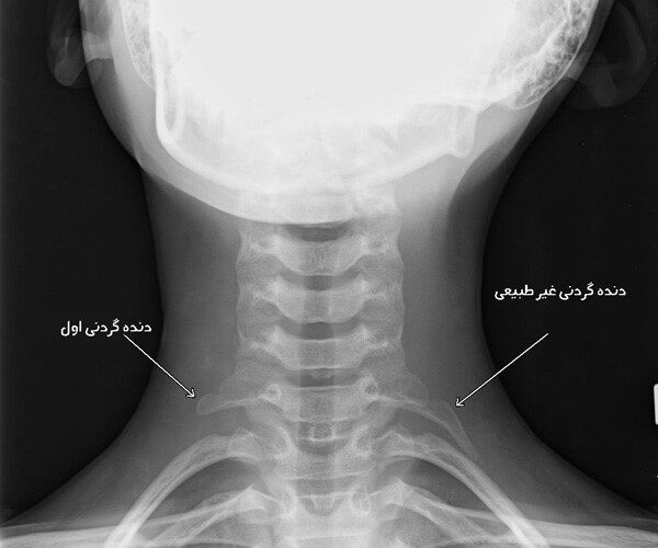 دنده گردنی دنده گردنی