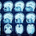 علایم عصبی یا نورولوژیک ویروس کرونا