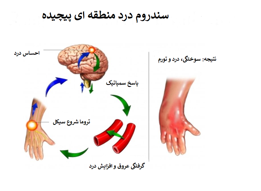 سندرم درد منطقه ای پیچیده 