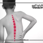 اسکولیوز در کودکان: علائم، تشخیص و درمان