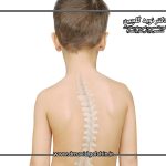 اسکولیوز در کودکان: ظاهر فیزیکی چگونه تغییر می‌کند؟