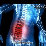 اسکولیوز در بزرگسالان: آیا درمان محافظه‌کارانه کافی است یا باید جراحی کرد؟