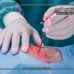 آیا جراحی ستون فقرات با لیزر واقعا مؤثر است یا بیشتر یک تبلیغ؟