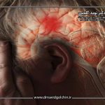 اولین علائم سکته مغزی چیست و چطور باید واکنش نشان داد؟