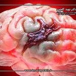خونریزی مغزی دقیقا چه زمانی اتفاق می افتد و چگونه تشخیص داده می شود؟