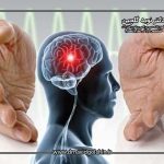 بهترین روش های پیشگیری از سکته مغزی در سال 2025 چیست؟